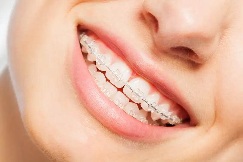 Girl smiling with Braces