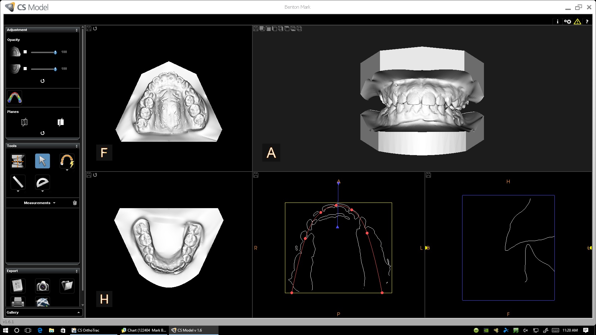 modelo dental 3D sin impresión
