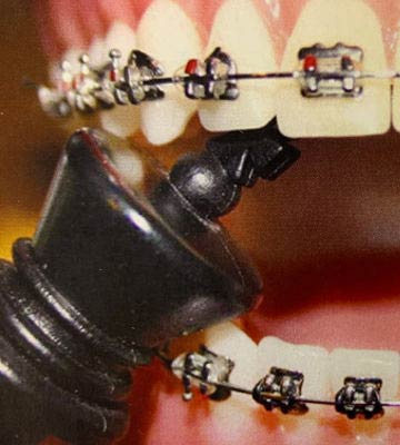 Chessmile braces