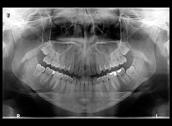 radiografía digital de la boca