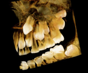radiografía digital de los dientes impactados