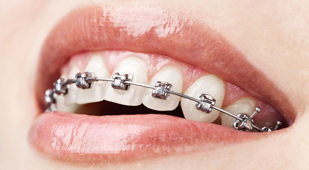 Adult metal braces